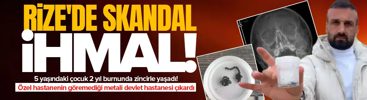 5 yaşındaki çocuğun burnundan 2 yıllık tırnak makası zinciri çıktı