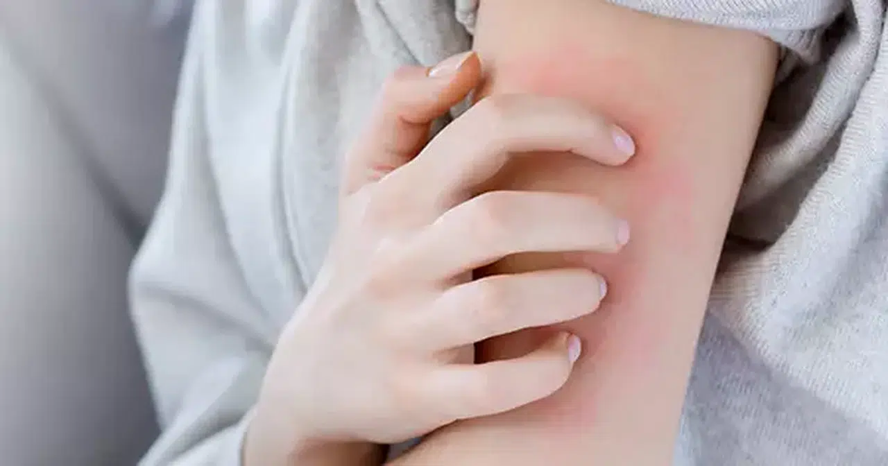 Sosyete uyuzu nedir? Temiz insanlarda bile görülüyor! İşte sosyete uyuzunun belirtileri ve bulaşma yolları