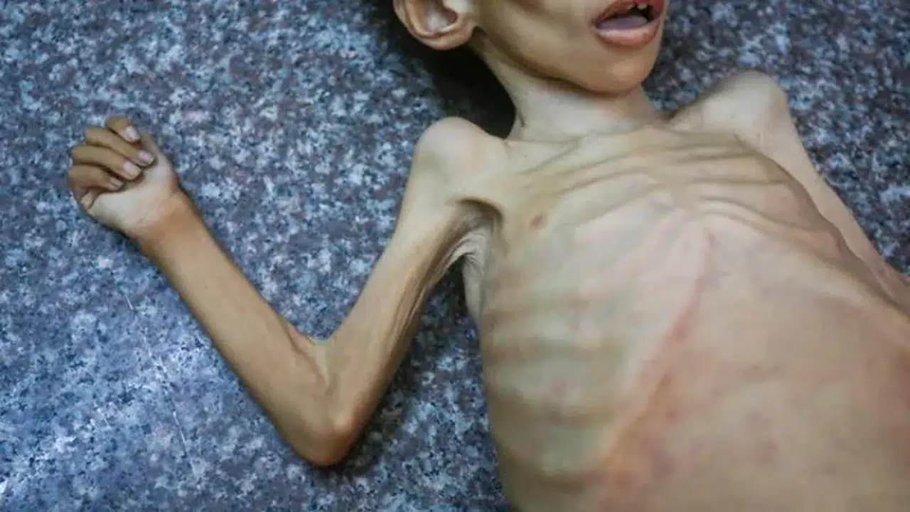 Gazze'de felaket büyüyor: Bir çocuk daha açlıktan hayatını kaybetti