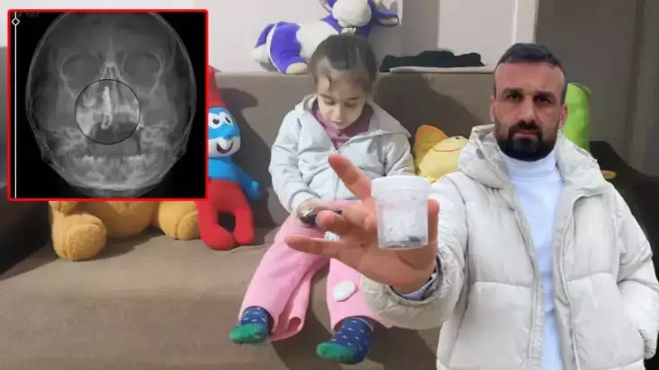 Rize'de inanılmaz olay : 5 yaşındaki çocuğun burnundan 2 yıllık tırnak makası zinciri çıktı
