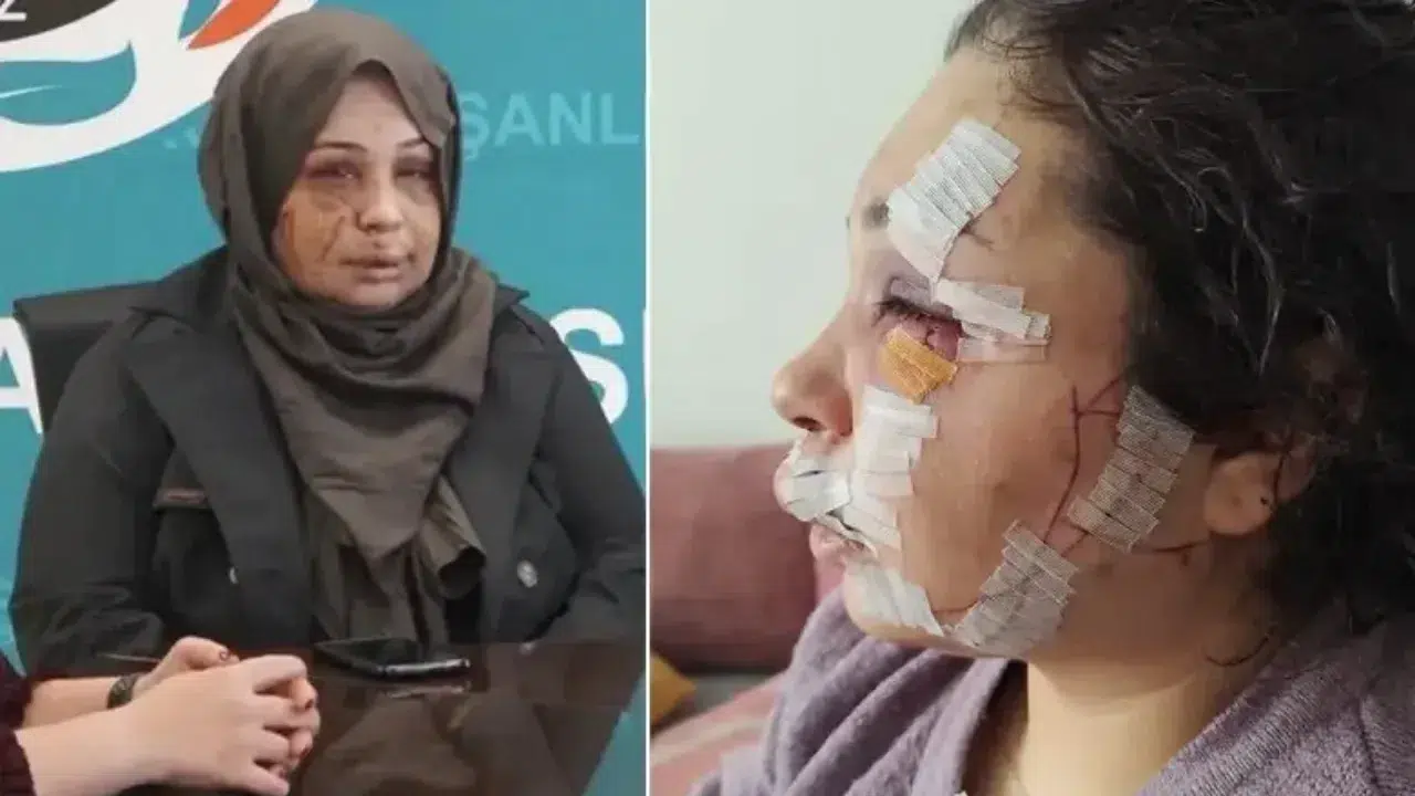 Ankara'da korkunç olay : Boşanmak isteyen eşinin yüzünü tırnak makasıyla yaraladı !