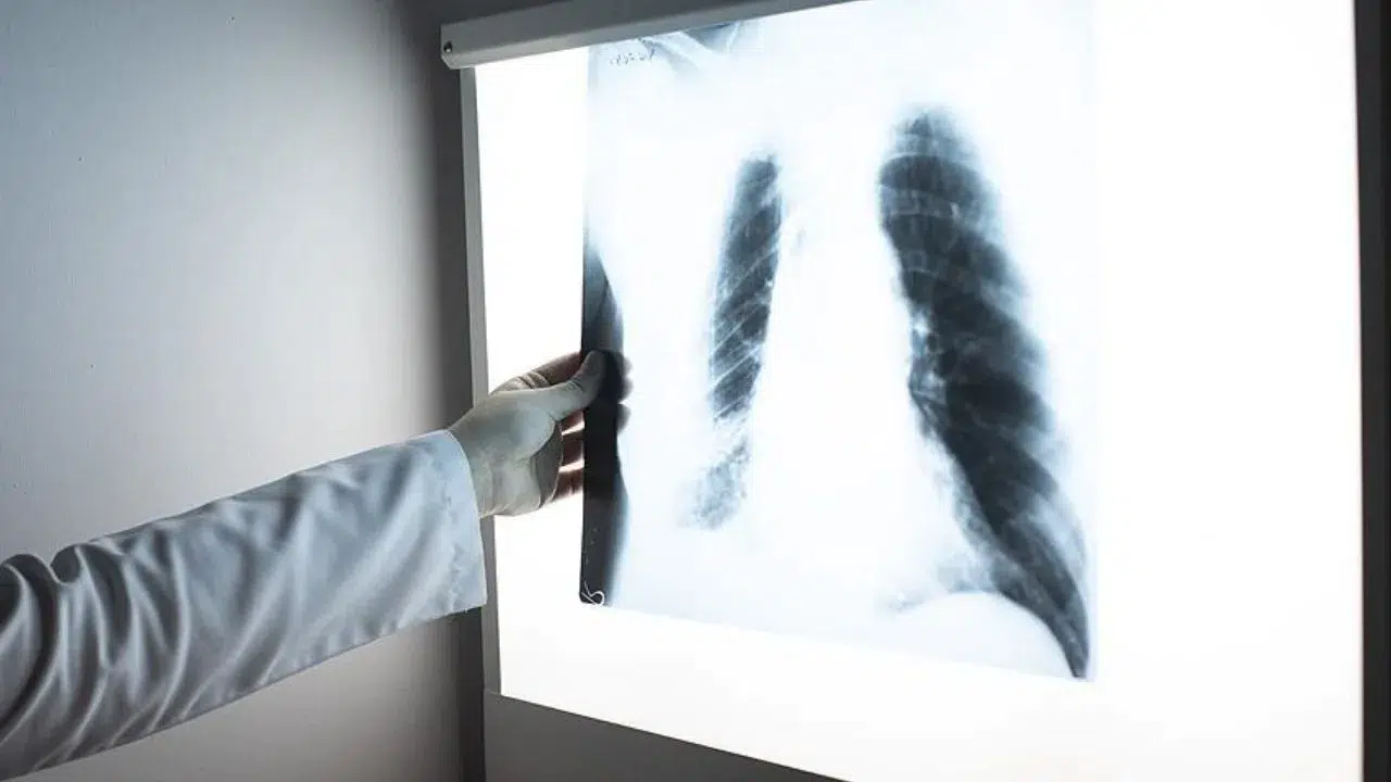 Türkiye'de tüberküloz vaka sayısı 9 bine düştü