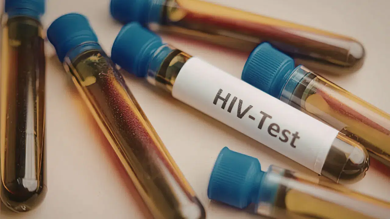 Türkiye'de HIV vakaları artışta : Uzmanlar ileri evre teşhisine karşı uyarıyor