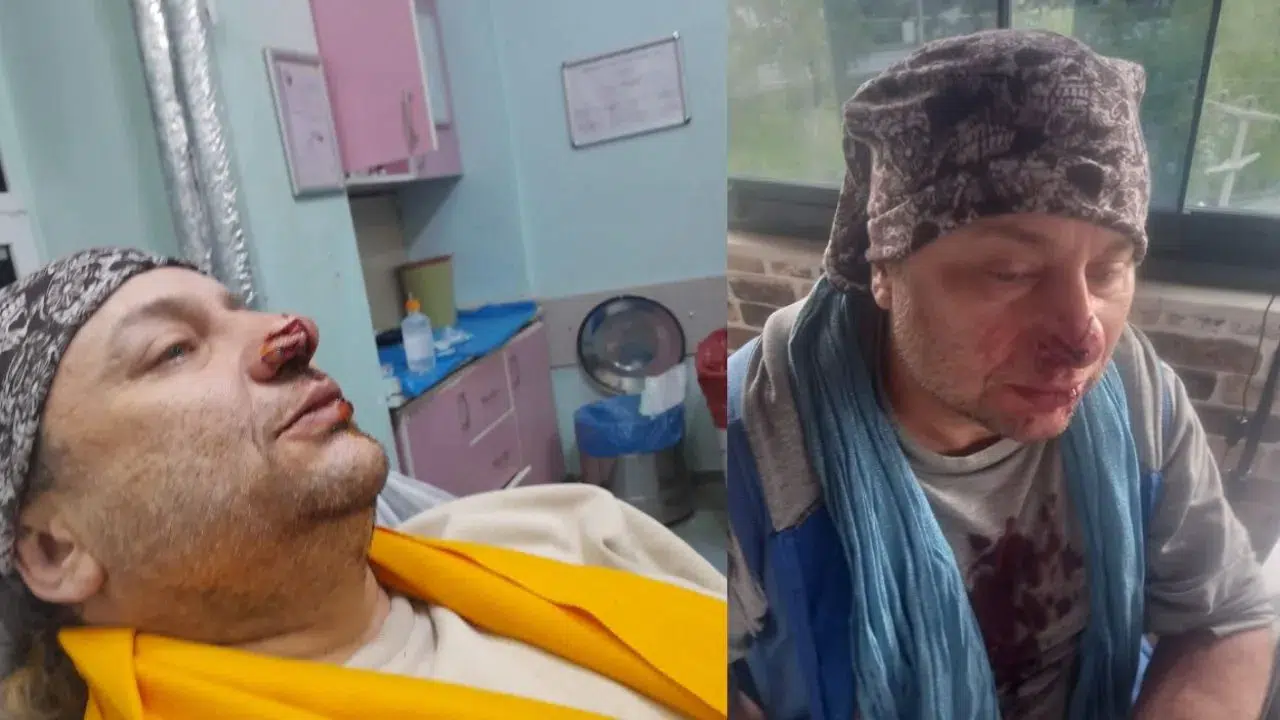 Sanatçı Onur Akay'a pitbull saldırdı : Burnundan parça koptu