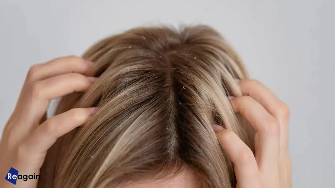 Saç deriniz sağlığınızla ilgili hangi sinyalleri veriyor? Saç derisinde görülen belirtiler ve anlamları