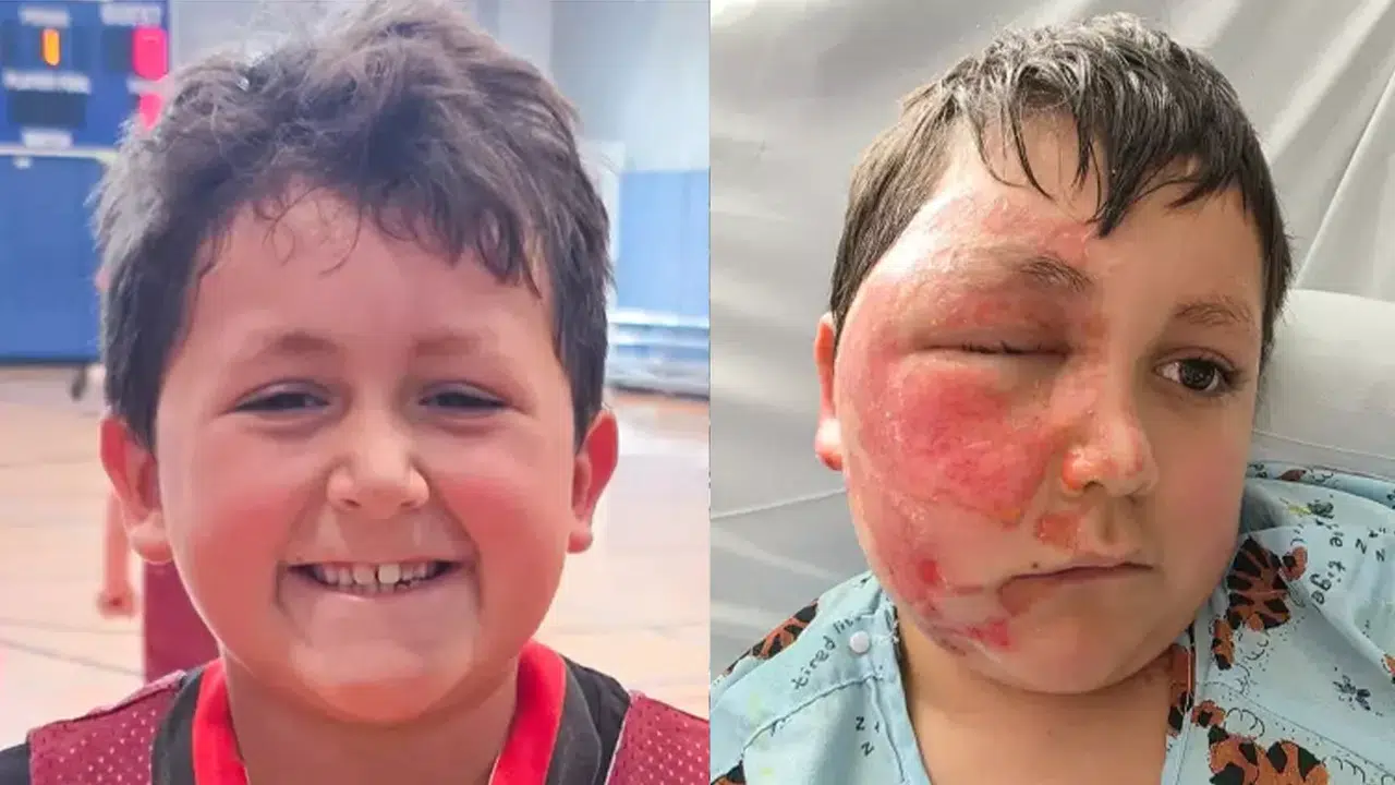 Sosyal medya trendleri kabusu yaşattı : Oyuncak yüzünde patladı