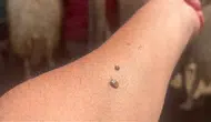 Kene ısırığında ne yapmalısınız? İşte uzmanından kritik tavsiyeler