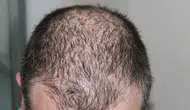 Saç dökülmesine karşı üçlü ilaç tedavisi : %82 başarı