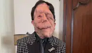 Adam Pearson kimdir, kaç yaşında ve hastalığı nedir? Oscar’a damga vuran oyuncunun biyografisi