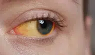Gözlerdeki Sararma Belirtisi Ne Anlama Geliyor ve Hangi Hastalıkların Habercisi Olabilir?