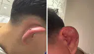 Bursa'da piercing yaptıran 17 yaşındaki çocuk hastanelik oldu