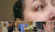 Göz kapağındaki şişliği arpacık sandı, nadir kanser teşhisi konuldu: Tükürük bezi kanserinin belirtileri neler?