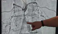 Bel Fıtığı Şikayetiyle Başvurdu, Ana Damarının Tıkalı Olduğu Anlaşıldı