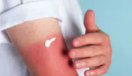 Güneş yanıklarından kurtulmak için doğal yöntemler nelerdir?