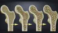 D vitamini takviyesi yeterli mi? İleri yaşlarda osteoporoz riski artıyor
