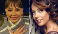 Ebru Gündeş'in estetik operasyonu sonrası görünümü nasıl?