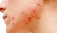 Dermatologlara göre ergenler için doğru cilt bakım rutinleri neler olmalı ?