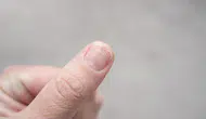 Tırnak diplerindeki renk değişimi neden olur ? Hangi hastalığın habercisi ?