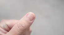 Tırnak diplerindeki renk değişimi neden olur ? Hangi hastalığın habercisi ?