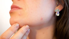 Dünya tarihinde bir ilk: Sivilce aşısı geliyor
