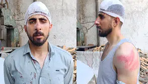 Şanlıurfa'da 'yavaş gidiyorsun' tartışması : Sürünün burnu kırıldı, başına 8 dikiş atıldı