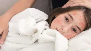 Kızamık patlaması : 35 yılın en yüksek seviyesi