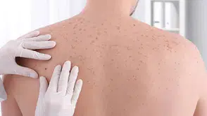 İyileşmeyen yaralara dikkat : Cilt kanserinin habercisi olabilir