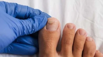 Oje ile kapattı, aylar sonra gerçek ortaya çıktı: Tırnağındaki morluk ölümcül kanser çıktı!
