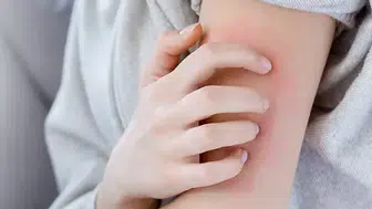 Sosyete uyuzu nedir? Temiz insanlarda bile görülüyor! İşte sosyete uyuzunun belirtileri ve bulaşma yolları