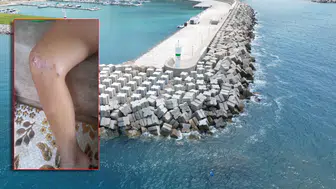 Küçük çocuk denize girdi, vücudunda yaralar çıktı! Gazipaşa’da endişe yaratan olay