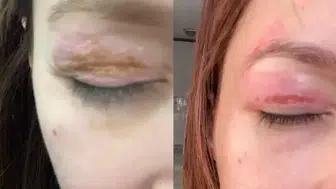 Güzellik salonundaki işlem sonrası gözünde hasar iddiası : Şikayeti reddedildi