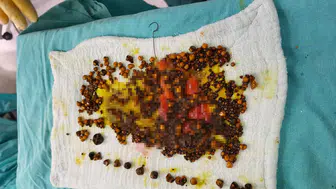 Manisa'da karın ağrısı şikayetiyle hastaneye gitti, safra kesesinden birçok taş çıkarıldı