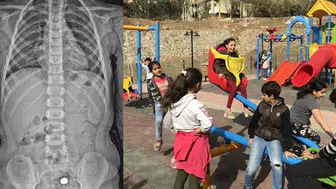 Parkta bulduğu pili şeker sanıp yuttu : 4 yaşındaki çocuğun midesi yandı