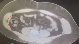 Kars'ta yakalanan kuryenin midesinden 76 kapsül uyuşturucu çıktı