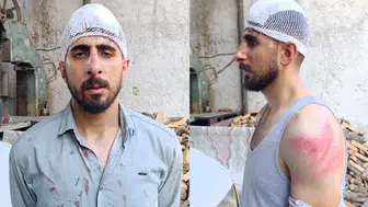 Şanlıurfa'da 'yavaş gidiyorsun' tartışması : Sürünün burnu kırıldı, başına 8 dikiş atıldı