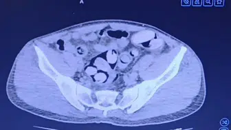 Kırşehir'de bir şahsın midesinden 1 kilo uyuşturucu çıktı