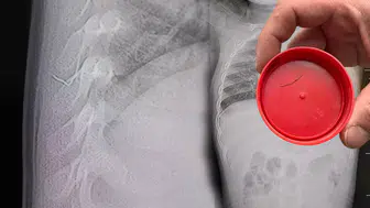 Kahramanmaraş'ta Bebeğin Sırtından Çıkan Yabancı Cisim Nedir?