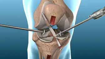 Ön Çapraz Bağ Ameliyatı Sonrası Spora Dönüşte Dikkat Edilmesi Gerekenler Neler?