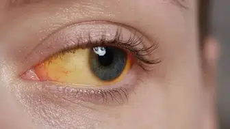 Gözlerdeki Sararma Belirtisi Ne Anlama Geliyor ve Hangi Hastalıkların Habercisi Olabilir?