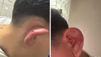 Bursa'da piercing yaptıran 17 yaşındaki çocuk hastanelik oldu