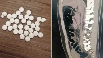 Bolu'da Midesinden Kilo ile Uyuşturucu Çıktı