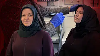 Trafik Kazası Sonrası Burnundan Gelen Sıvı Beyin Omurilik Sıvısı Çıktı