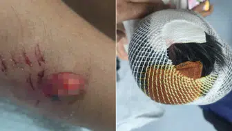 Viranşehir'de Okul Dönüşü Köpek Dehşeti: Çocuğun Başına 15 Dikiş Atıldı