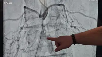 Bel Fıtığı Şikayetiyle Başvurdu, Ana Damarının Tıkalı Olduğu Anlaşıldı