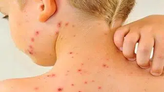 Bangladeş'te kızamık salgını neden bu kadar hızla yayılıyor ve çocuklar neden etkileniyor?