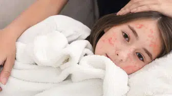 Kızamık patlaması : 35 yılın en yüksek seviyesi