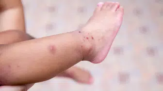 Çocuklarda el ayak ağız hastalığı neden artıyor?
