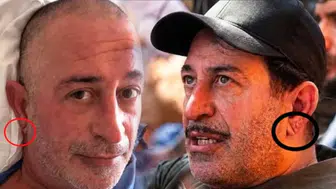 Kulak memesindeki frank çizgisi gerçekten kalp krizi belirtisi mi?