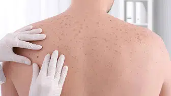 İyileşmeyen yaralara dikkat : Cilt kanserinin habercisi olabilir