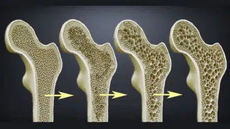 D vitamini takviyesi yeterli mi? İleri yaşlarda osteoporoz riski artıyor